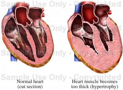 Effects of steroids on the heart